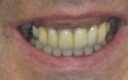after deflex dentures