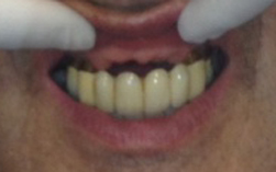 before deflex dentures
