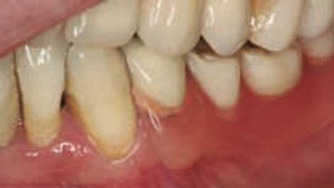 valplast flexible partial dentures showing lower plate